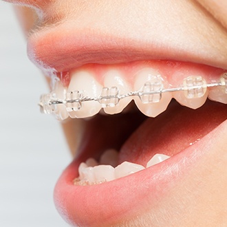Smile with clear and ceramic brackets and wires