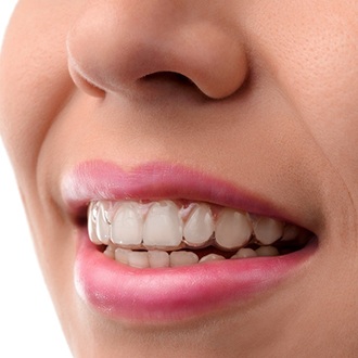 An up-close image of a person’s mouth and an Invisalign aligner being worn on the top row of teeth