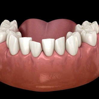 A digital image of overcrowded teeth in Marlborough