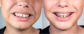 A boy with gapped teeth before and while wearing braces in Marlborough