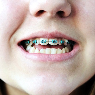 A young girl with an open bite in Marlborough and wearing braces