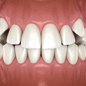 A digital image of impacted canine teeth in Marlborough