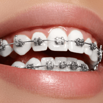 Closeup of teeth with self-ligtaing braces