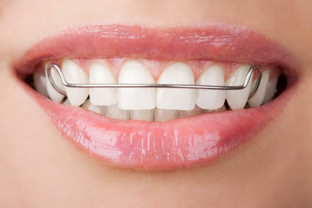 Closeup of woman smiling with retainer