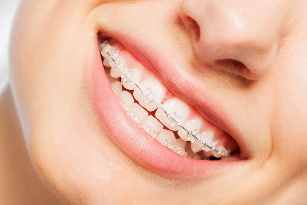 Closeup of woman smiling with metal braces